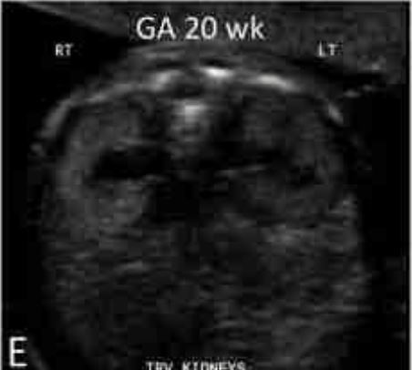 Εμβρυο 22+2 εβδομάδων . Εμφανίζεται διάταση στον νεφρό .